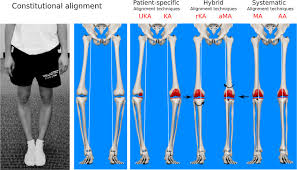 Alignment Options For Total Knee Arthroplasty A Systematic