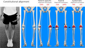 alignment options for total knee arthroplasty a systematic