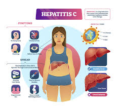 Image result for hepatitis symptoms