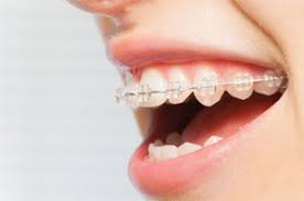 Check out all things about how to remove stains from braces. Clear Braces Tulsa Ok Sand Springs Ok Galleria Of Smiles