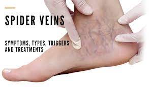 Spider Veins On Ankles Vein Solutions