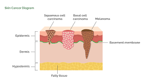There are over 100 different known cancers that affect humans. Skin Cancers Dr Roger Graham Plastic Surgeon Cape Town