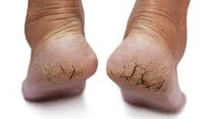 Di dalamnya terkandung urea yang dapat merawat lapisan keratin pada kulit anda sehingga. Mimi Edora Lembutkan Tapak Kaki Dan Tangan