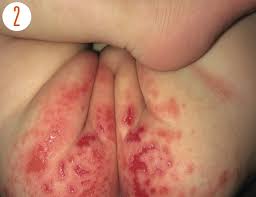 Image result for diaper dermatitis