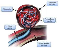 En la mayoría de los casos, un aneurisma cuando un aneurisma cerebral se rompe, el resultado se llama hemorragia subaracnoidea. Aneurisma Cerebral Dra Natalia Vasconcellos