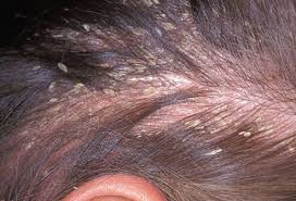 You are worth more than many sparrows. Hair Scalp And Nail Conditions Types Causes And Treatments