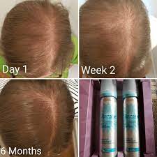 Megatron, i see what you're saying. Tips To Stop Hair Loss With Regaine News Dentagama