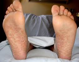 Maybe you would like to learn more about one of these? You Are Too Brash If You Ignore The Rash Bmj Case Reports