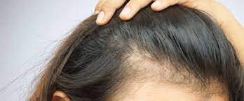 Usually in patches or around the hairline, at first it may not even be noticeable, but as the patches join up, it becomes more obvious. Localized Hair Loss Ducray