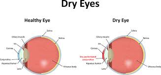 Image result for Dry Eye