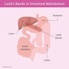 Image result for Intestinal Malrotation