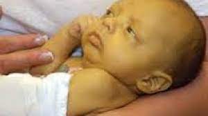 Meski begitu, pada kasus tertentu, penyakit kuning dapat menyebabkan kerusakan. 7 Cara Penanganan Bayi Kuning Hamil Co Id