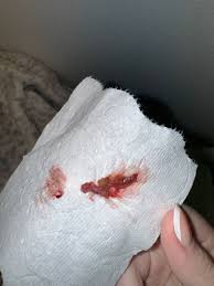 Image result for Retained Placenta