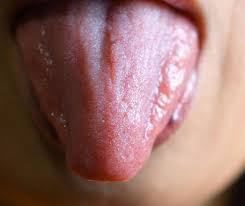 Image result for Puchýře na jazyku