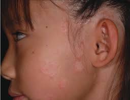 Which topical therapy would be best for treating this patient's facial  psoriasis?