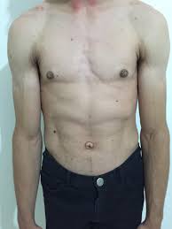 The clinical and imaging features of the syndrome are mostly due to fat deficiency, diabetes, or to manifestations of secondary hyperinsulinemia, which results from the failure of the. Epos Trade