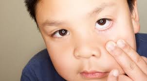 Pink Eye What Parents Should Know Choc Children S Blog