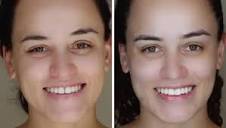 Agenesia dental” | By Clínica Renata Avighi | Hello, my name is ...