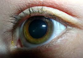 Glaucoma is an eye disease that damages your eye's optic nerve and it is a condition that often gets gradually worse over time. New Eye Test Could Detect Glaucoma Years Earlier Unsw Newsroom