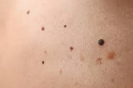 They may have hair growing from them. Mole Removal Pittsburgh Prizant Dermatology Pittsburgh Pa