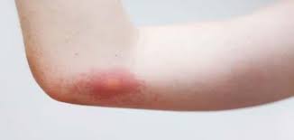 علاج حساسية لدغ الحشرات افضل طرق علاج لدغ الحشرات صور حزينه