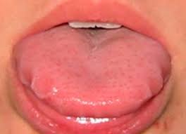Sabias Que Tu Lengua Dice Mucho Sobre Tu Estado De Salud Clinica Dental En Leon Dentistas En Leon