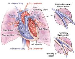 Pin On Pulmonary Hypertension Congenital