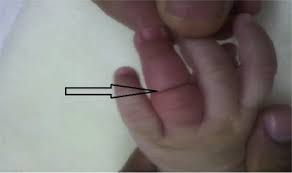 Lucky it was found and the hair removed in time. many parents shared their stories of experiencing similar situations with their own babies. Hair Tourniquet Syndrome Successful Management With A Painless Technique Sciencedirect