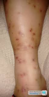 Image result for mite bites on humans