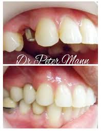 Image result for dental implant