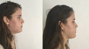 I Had To Survive On A Liquid Diet After Having Jaw Surgery