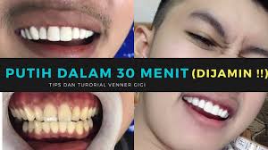 Perawatan behel gigi tambal gigi gigi palsu scaling. Cara Memutihkan Gigi Dengan Cepat Terbukti Pengalaman Veneer Youtube