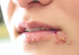 Everything about cold sores, night fever – The Sun Nigeria