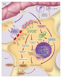 Image result for Stroke Pathophysiology