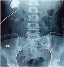 Multiple myeloma is a cancer of plasma cells, which are making excessive amounts of antibody (termed paraprotein or 'm' band). Cureus Far And Few Between Early Onset Multiple Myeloma In A 26 Year Old Female