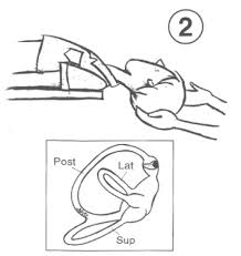 Image result for Canalith Repositioning Procedure