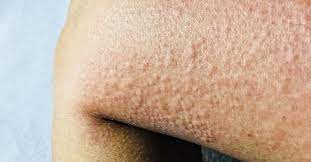 أعراض حساسية البرد وأبرز المعلومات عنها ويب طب