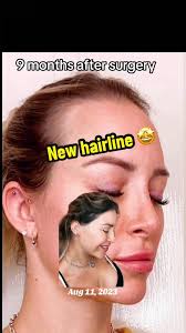 #hairline #hairloss #hairtransplant #fyp #foryou #foryoupage  #femalehairtransplant
