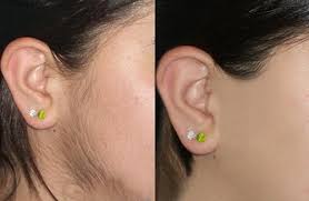 Avoid shaving or plucking the hair on your face for 3 days prior to treatment. Laser Hair Removal Treatment In Metro Detroit Michigan Cosmetic Surgery