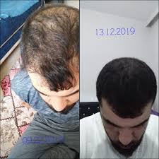Binox Kullananlar 3 Aylik Binox Serum Binox Sac Cikaran Mavi Su Serum Ve Sampuan Losyon Ilac Facebook