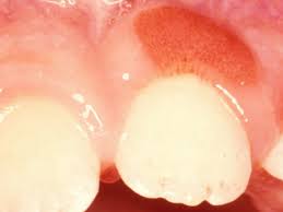 Abscesses or gum boils can also occur when a tooth has a large cavity, and the decay is so severe that the pulp (where the nerve and blood vessels are likely, your child will not complain of pain, as most kids have an amazing threshold for pain or discomfort. Swollen Gum Around One Tooth Causes And Treatment