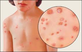 Why Is Measles Called Mata In India Newstrack English 1