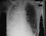 Collapsed Lung (Atelectasis) - Cedars-Sinai