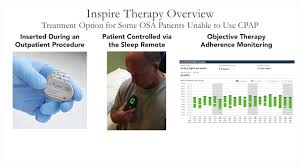 In some ways, inspire is similar to a cardiac pacemaker. Inspire Surgery For Sleep Apnea The Metrohealth System
