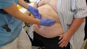 Magenbypass Operation Hilft Auch Gegen Diabetes Ndr De Ratgeber Gesundheit