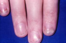 Image result for Nail Pitting