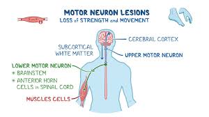 Image result for Neurologic Lesion Localization