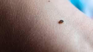 Image result for bedbugs bites