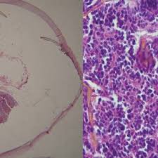 Calcification is almost pathognomonic of retinoblastoma, but its etiology is not known. Pdf Retinoblastoma In Adolescence Report Of An Unusual Presentation