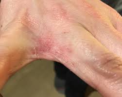 Image result for Connective Tissue Disorder